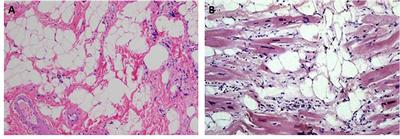Arrhythmogenic Cardiomyopathy and Skeletal Muscle Dystrophies: Shared Histopathological Features and Pathogenic Mechanisms